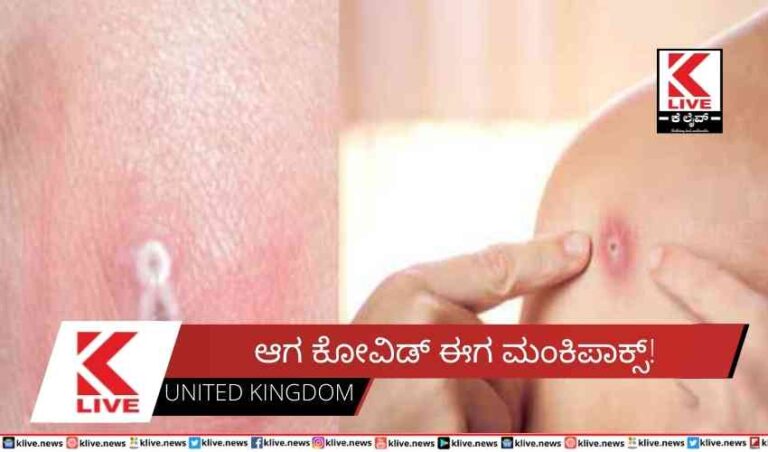 ಆಗ ಕೋವಿಡ್ ಈಗ ಮಂಕಿಪಾಕ್ಸ್!