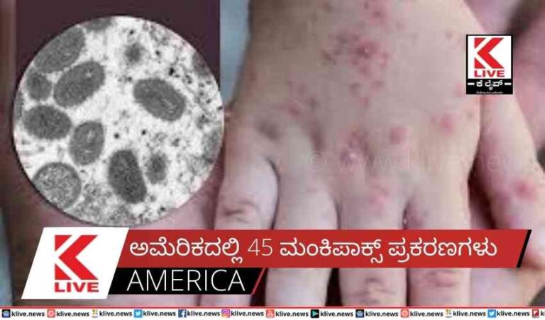 ಅಮೆರಿಕದಲ್ಲಿ 45 ಮಂಕಿಪಾಕ್ಸ್ ಪ್ರಕರಣಗಳು