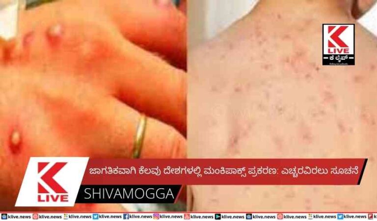 ಜಾಗತಿಕವಾಗಿ ಕೆಲವು ದೇಶಗಳಲ್ಲಿ ಮಂಕಿಪಾಕ್ಸ್ ಪ್ರಕರಣ: ಎಚ್ಚರವಿರಲು ಸೂಚನೆ