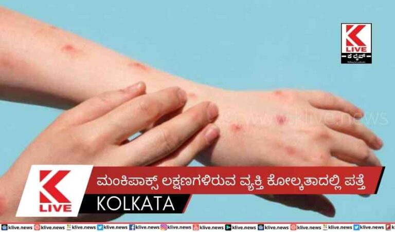ಮಂಕಿಪಾಕ್ಸ್ ಲಕ್ಷಣಗಳಿರುವ ವ್ಯಕ್ತಿ ಕೋಲ್ಕತಾದಲ್ಲಿ ಪತ್ತೆ