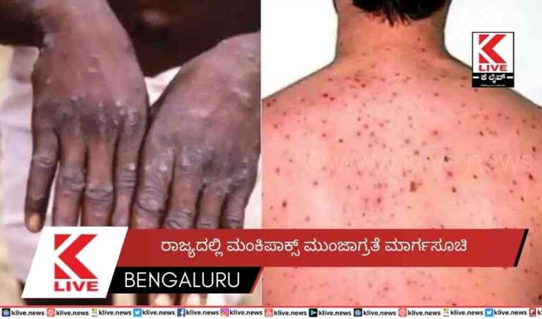 ರಾಜ್ಯದಲ್ಲಿ ಮಂಕಿಪಾಕ್ಸ್ ಮುಂಜಾಗ್ರತೆ ಮಾರ್ಗಸೂಚಿ