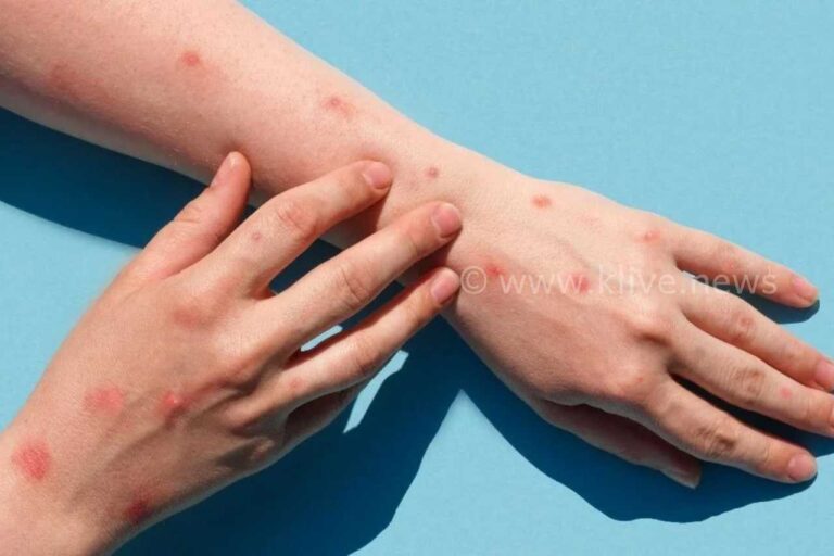 ದೆಹಲಿಯಲ್ಲಿ ಮಂಕಿಪಾಕ್ಸ್  ಪ್ರಕರಣ 12 ಕ್ಕೆ ಏರಿಕೆ