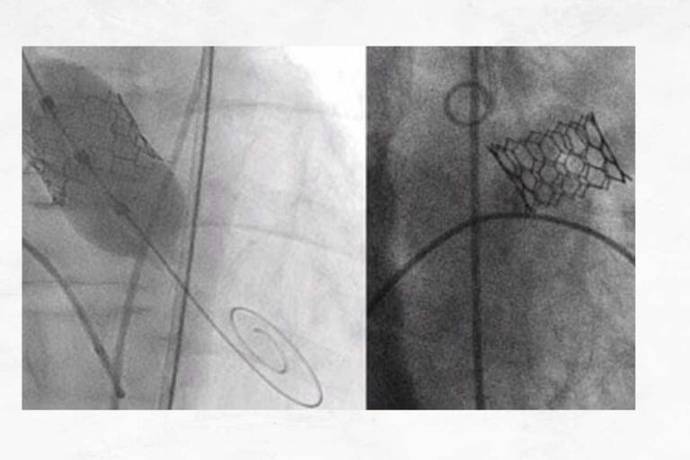 ತೆರೆದ ಹೃದಯದ ಶಸ್ತ್ರಚಿಕಿತ್ಸೆ ಇಲ್ಲದೇ ಕವಾಟ ಬದಲಿಸಿದ ಮಣಿಪಾಲ್ ವೈದ್ಯರ ಸಾಧನೆ